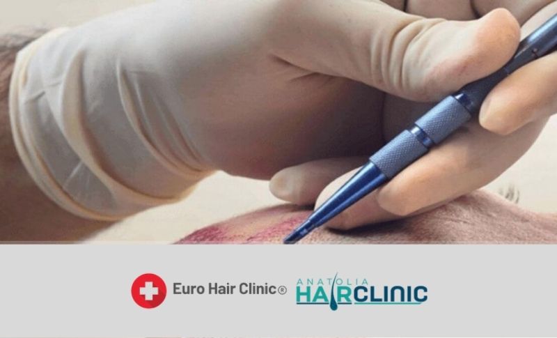 hair transplant in turkey