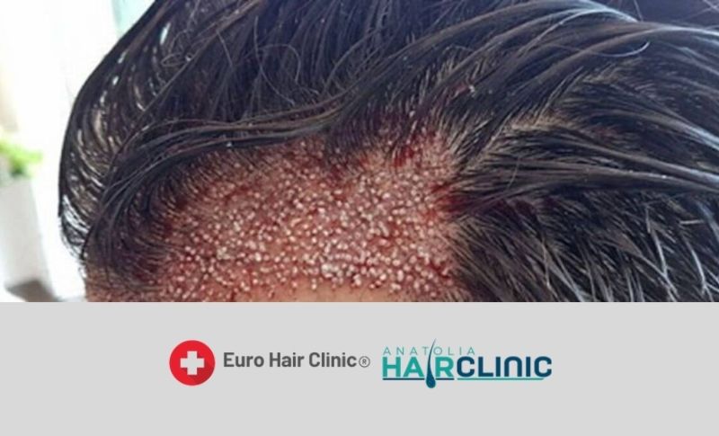 unrasierte Haartransplantation