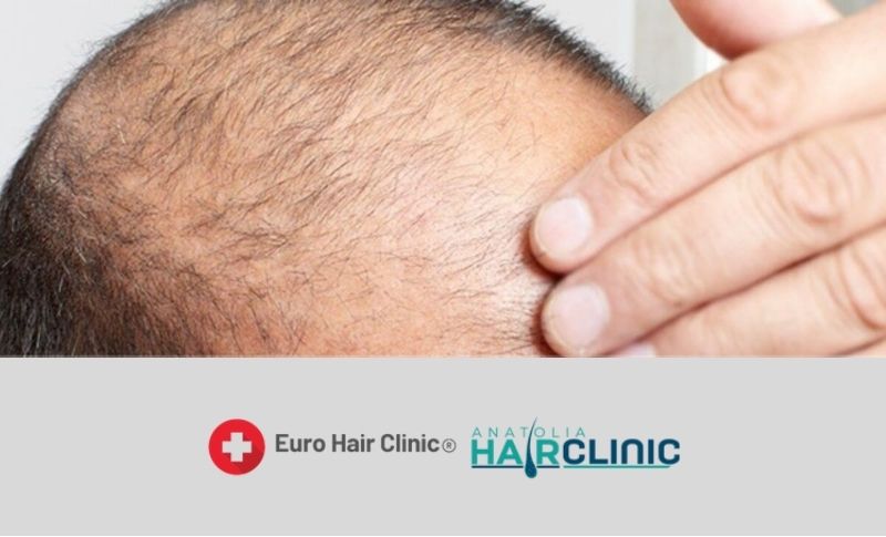 hair transplant in turkey