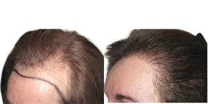 vor und nach Haartransplantation in der Türkei