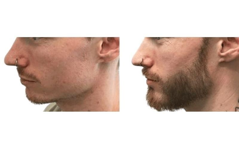 Injerto De Barba Antes Y Después