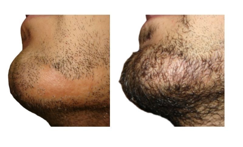 Injerto De Barba Antes Y Después
