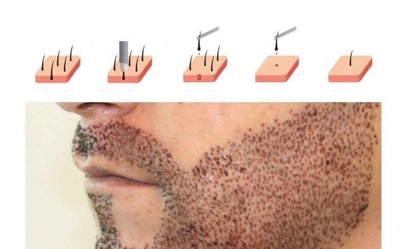 Injerto De Bigote