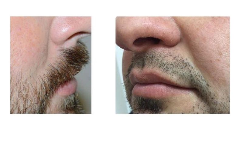 Injerto De Bigote