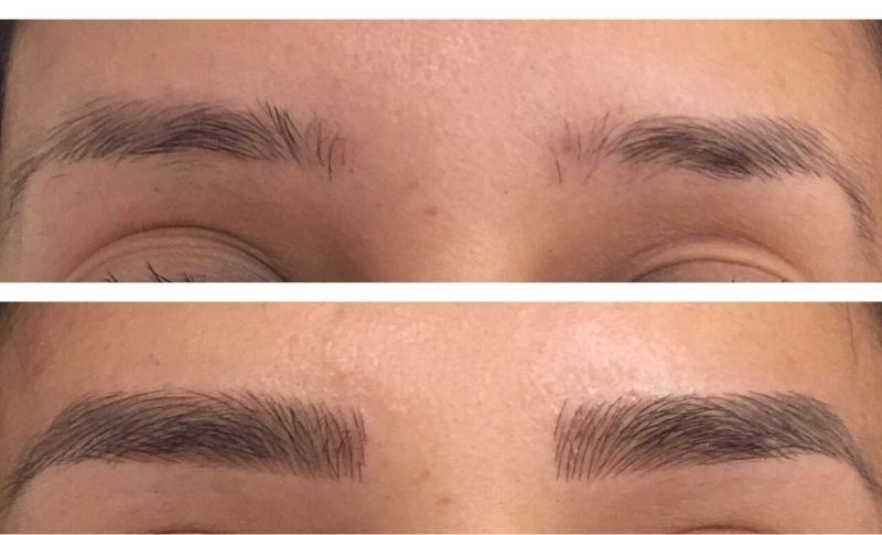 Injerto De Cejas