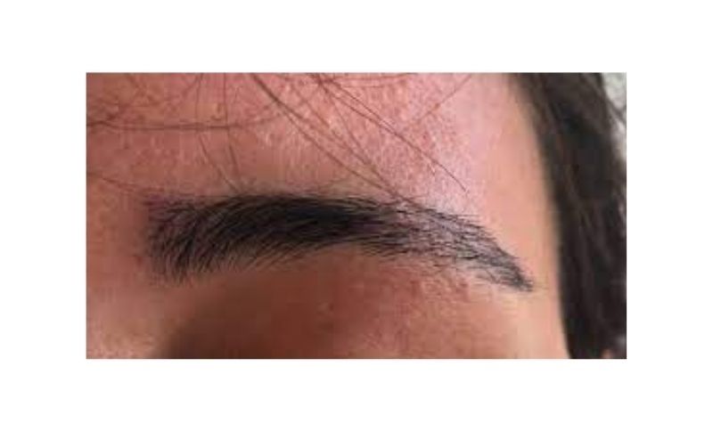 Injerto De Cejas