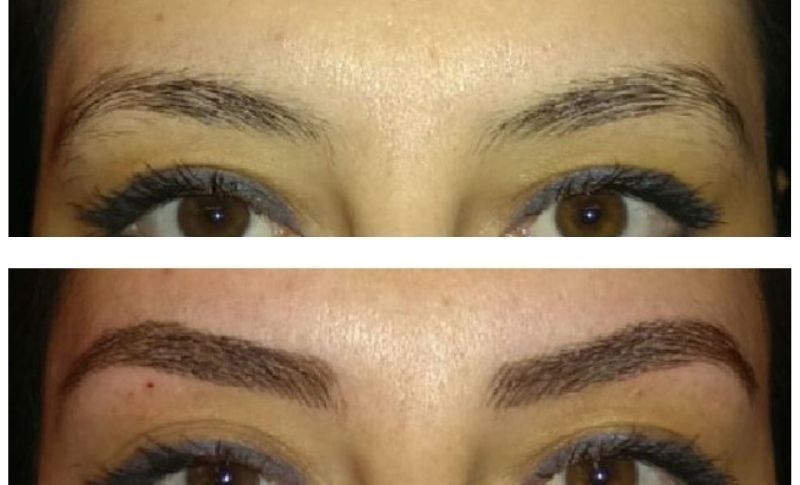 Injerto De Cejas