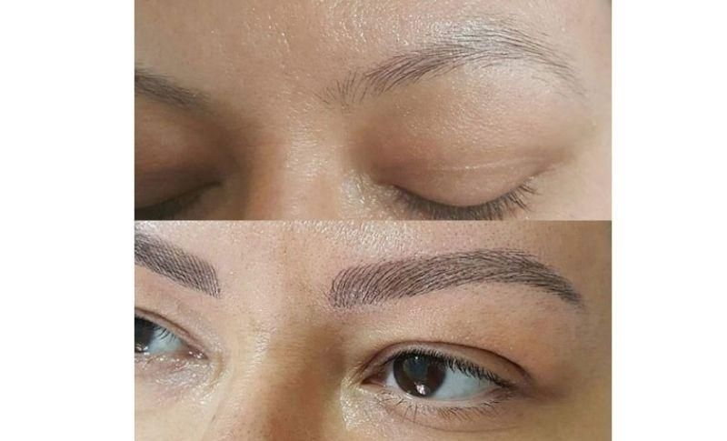 Injerto De Cejas